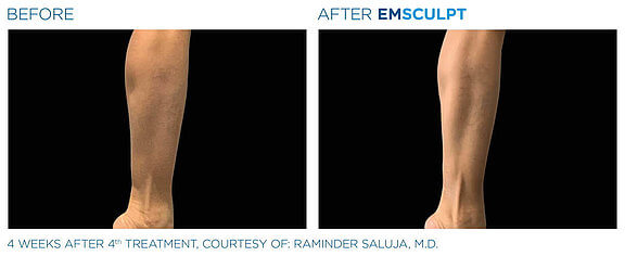 emsculpt-vorher-nachher-04-info-aesthetik.jpg 