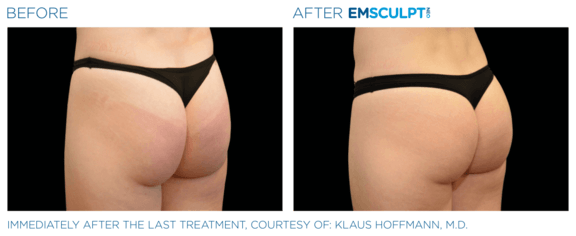 emsculpt-neo-vorher-nachher-08-info-aesthetik.png 