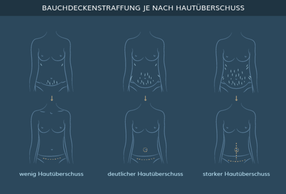 Graphik Bauchdeckenstraffung, info Ästhetik