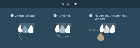 Graphik Veneers, info Ästhetik