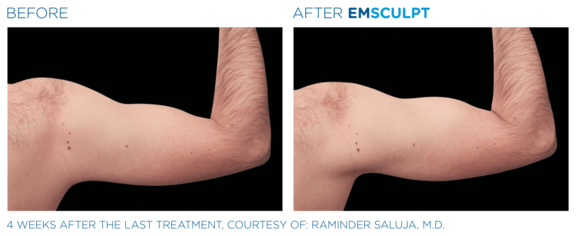 emsculpt-neo-vorher-nachher-01-info-aesthetik.png 