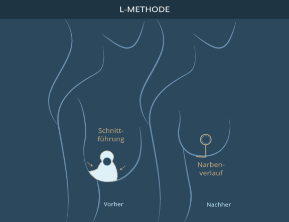 Graphik Brustverkleinerung L-Methode, info Ästhetik