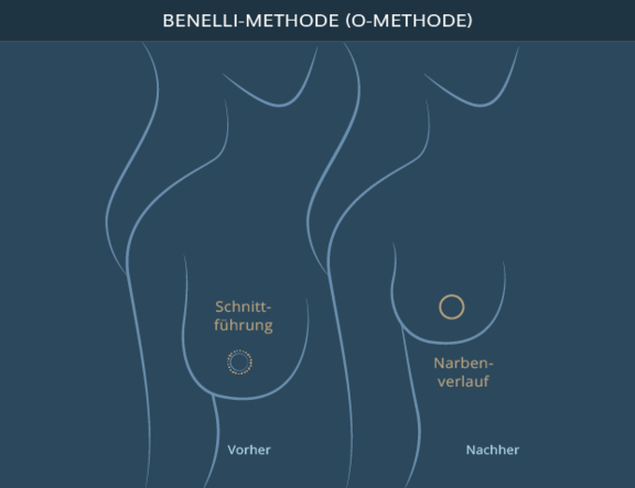 Graphik Brustverkleinerung O-Methode, info Ästhetik