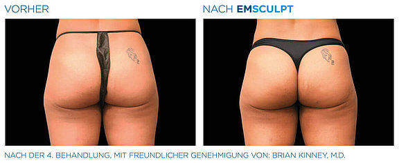 emsculpt-vorher-nachher-03-info-aesthetik.jpg 